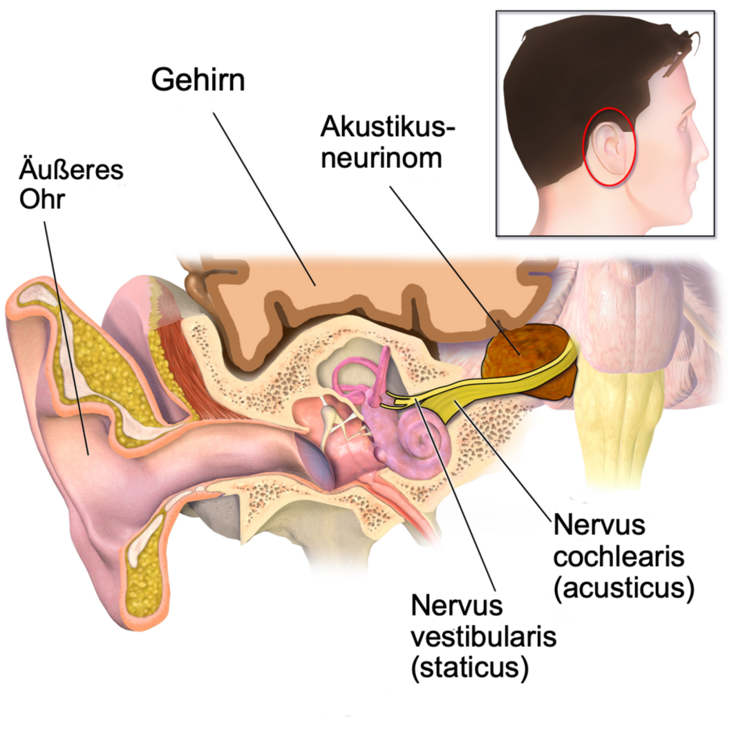 Typische anatomische Lage des Akustikusneurinoms