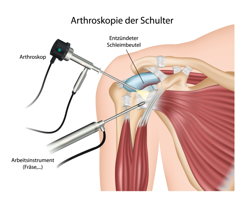 Arthroskopie der Schulter als Grafik mit Beschriftung